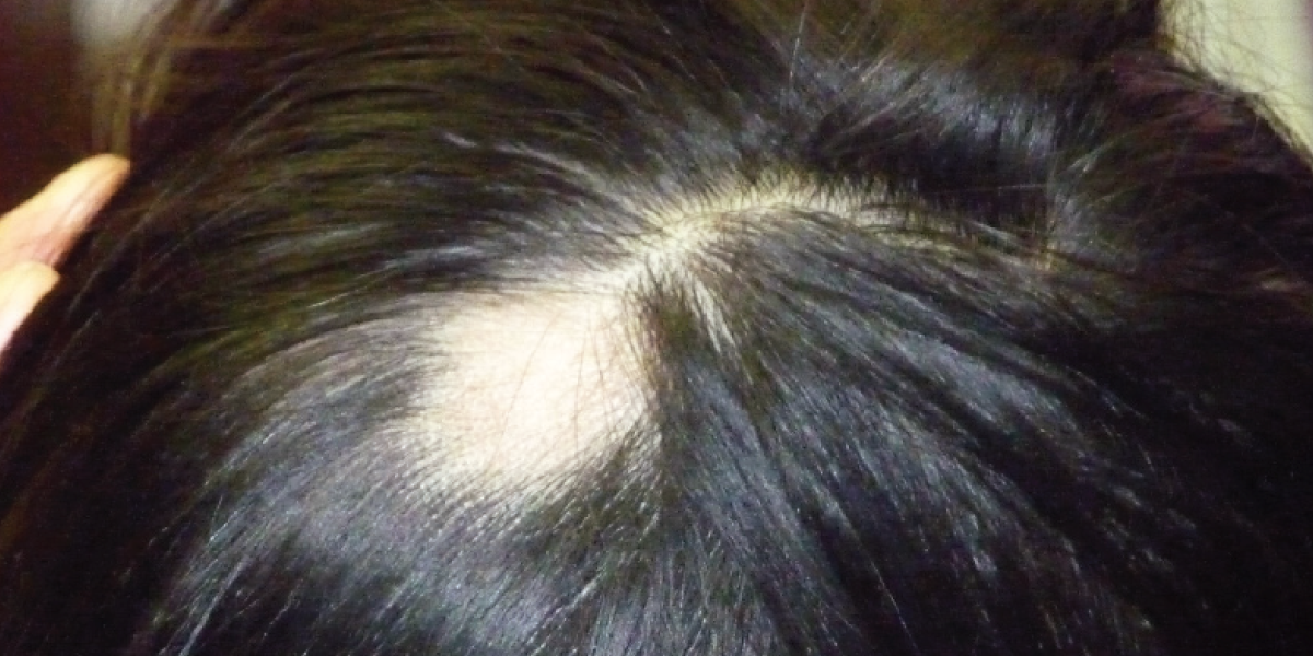 Bald Patches