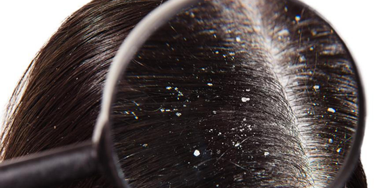 Dandruff