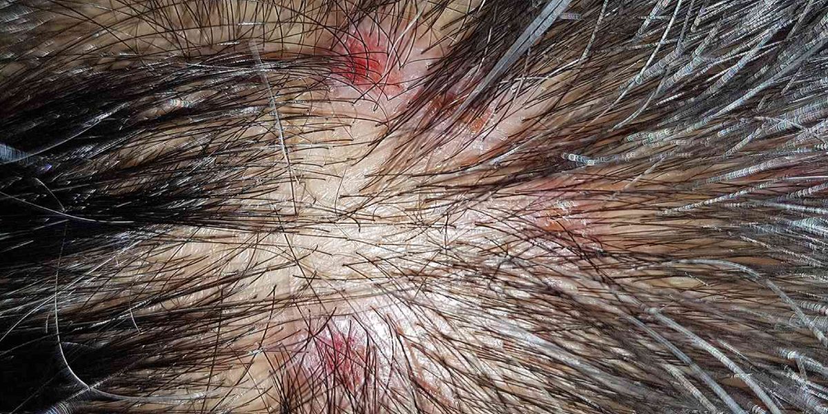 Folliculitis