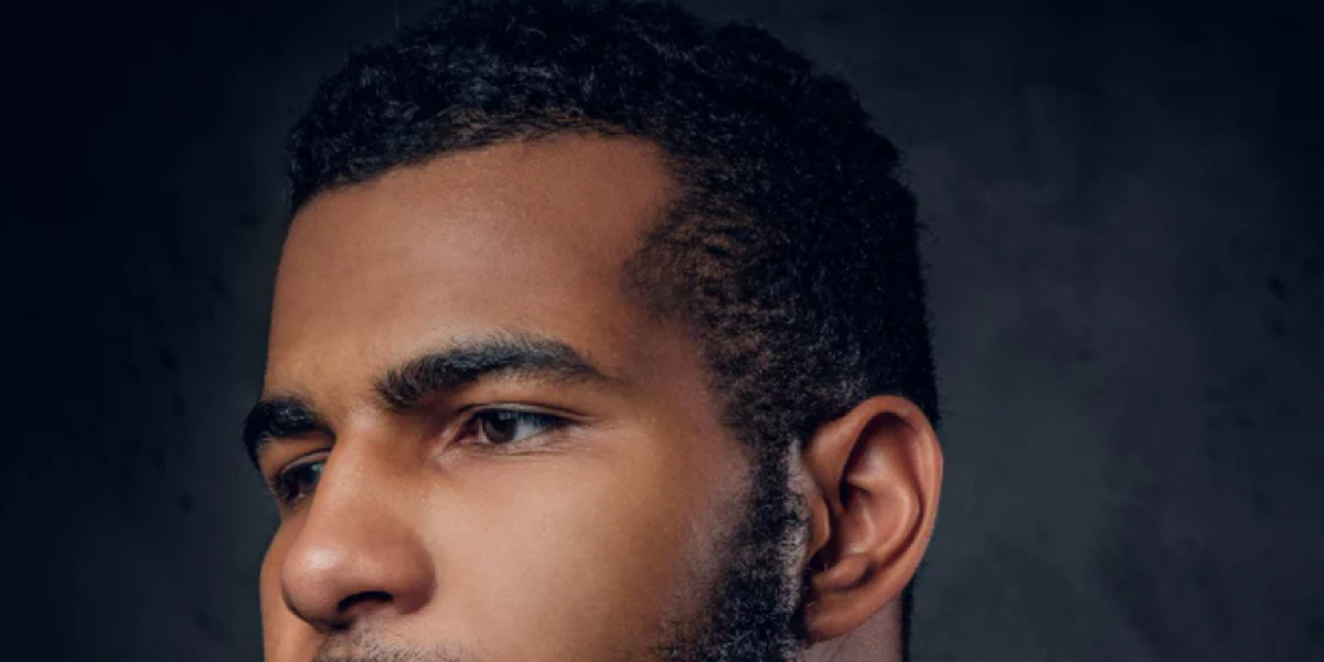 Receding Hairline