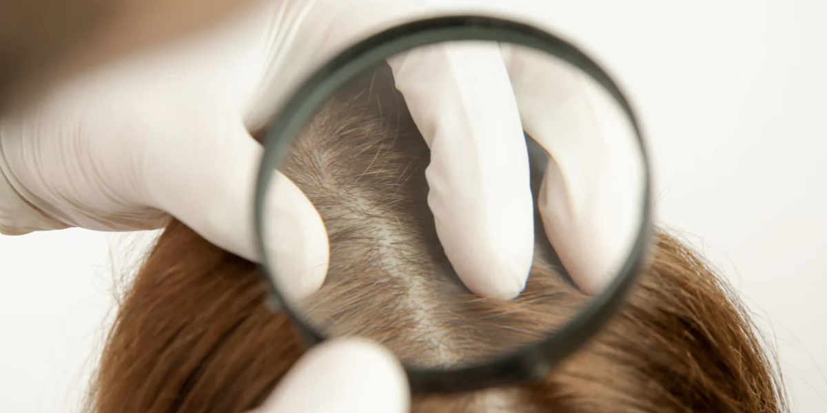 Scalp Acne