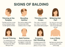 Signs of Balding