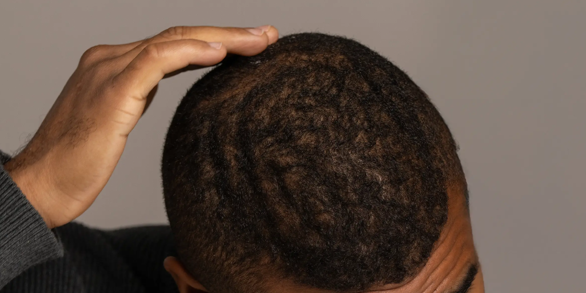 Thinning on the Crown