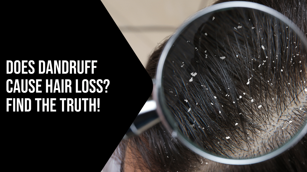 Does Dandruff Cause Hair Loss? Find the Truth!