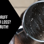 Does Dandruff Cause Hair Loss? Find the Truth!