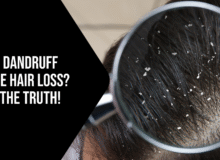 Does Dandruff Cause Hair Loss? Find the Truth!