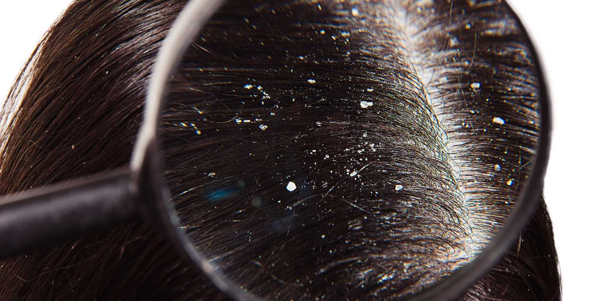 Does Dandruff Cause Hair Loss