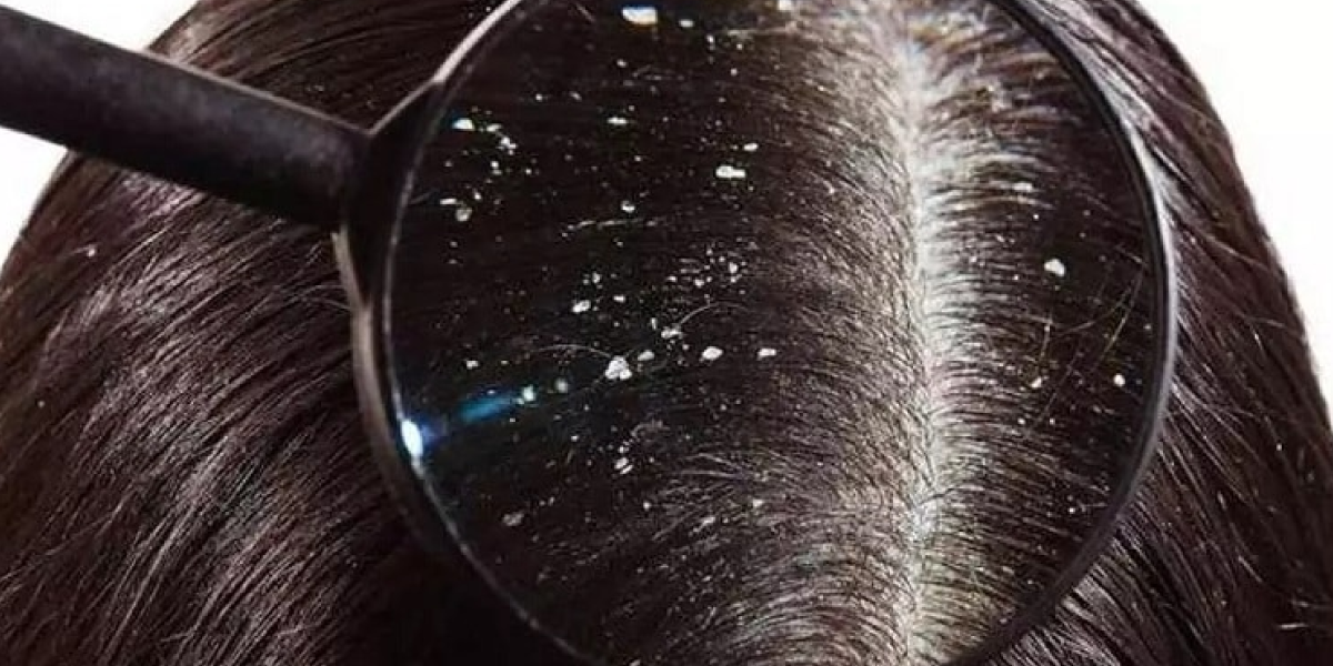 How to Regrow Hair After Dandruff