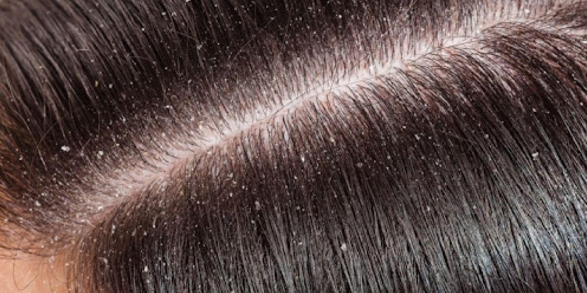 What Exactly is Dandruff