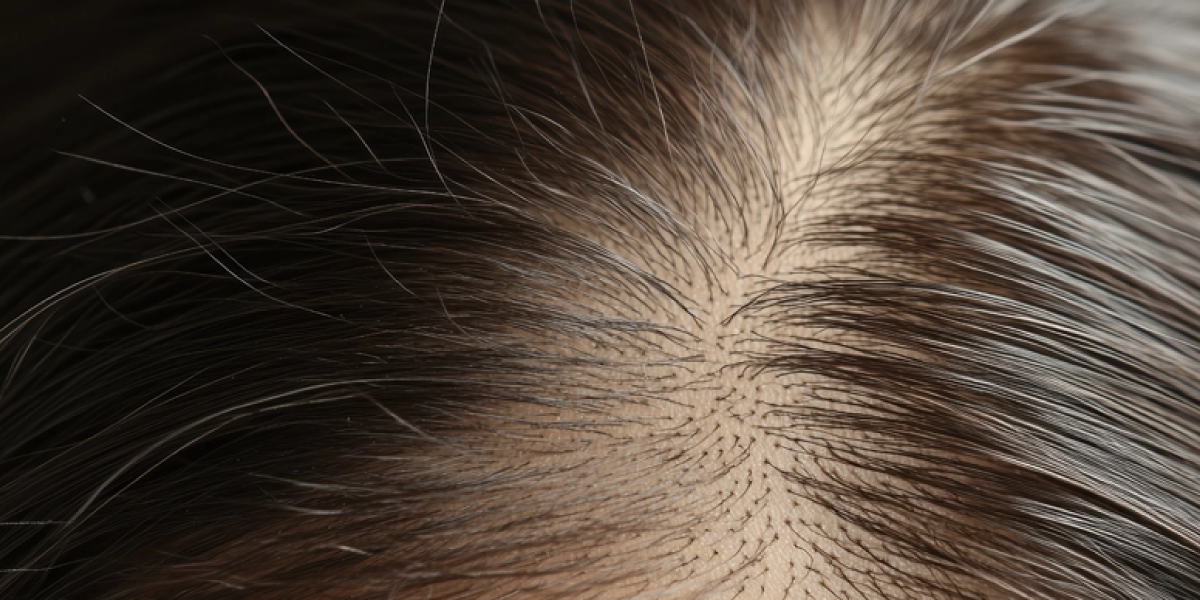 Thinning Hair in Women