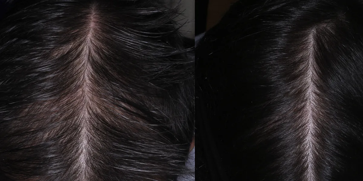 What is Female Pattern Baldness