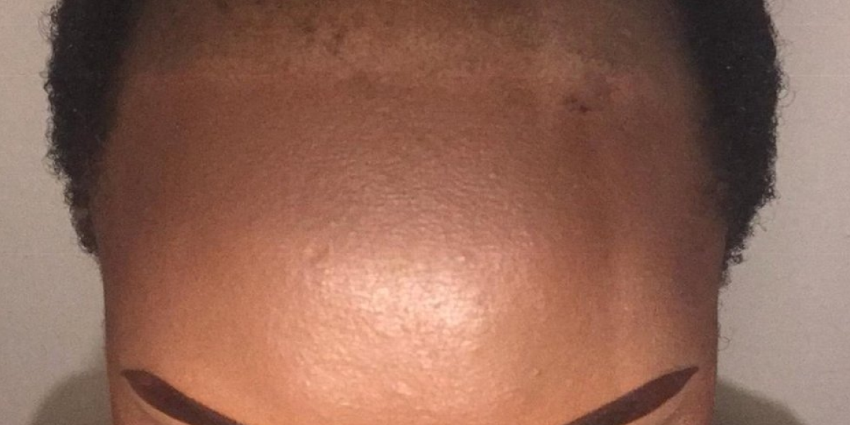 What is a Receding Hairline