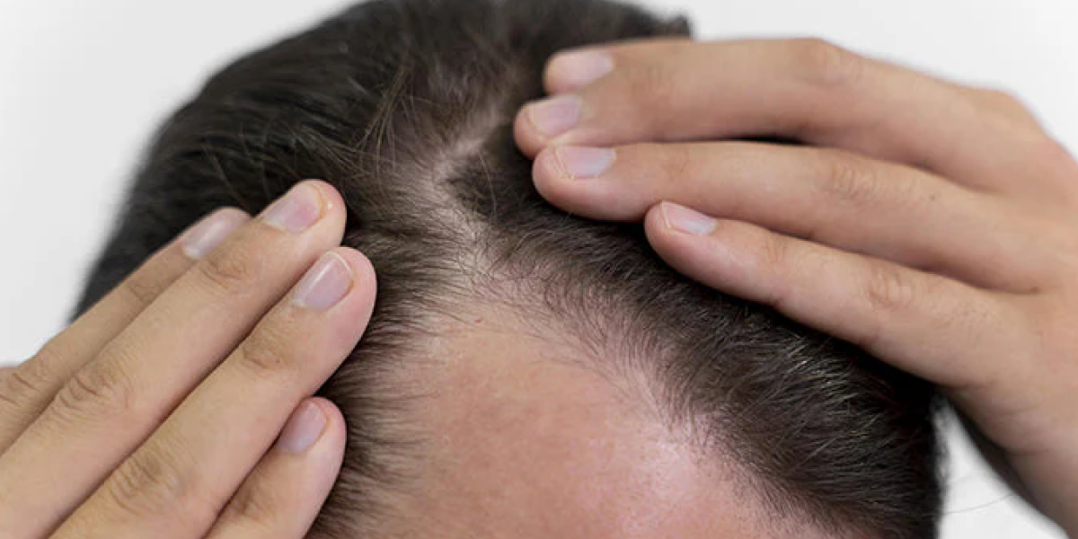 Why People Think Hats Cause Hair Loss