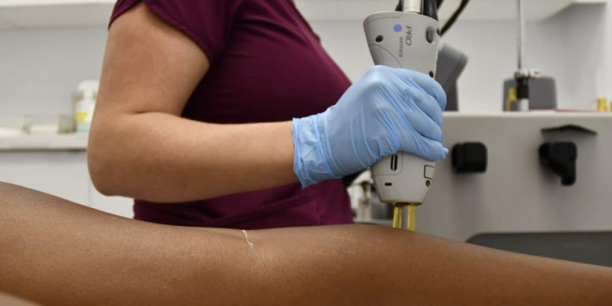 What is Laser Hair Removal?